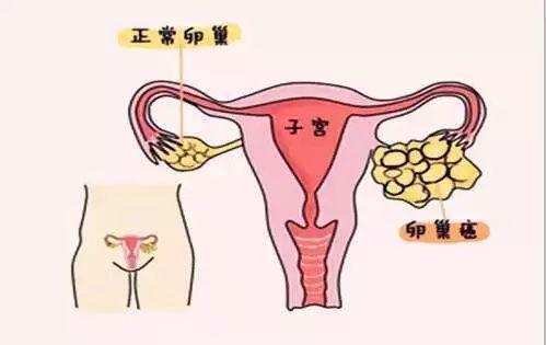 什么是卵巢癌的高危因素呢