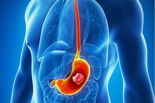 诱发胃癌发病的因素有哪些
