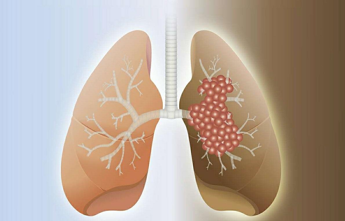 肺癌的病因